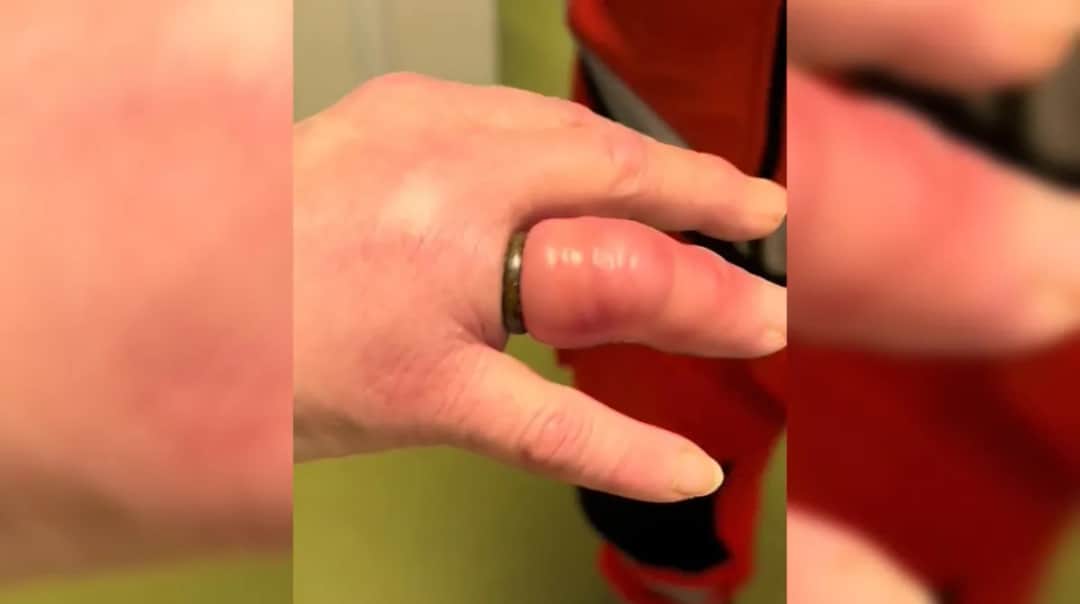 Jak zdjąć obrączkę nitką i uniknąć bólu przy spuchniętym palcu