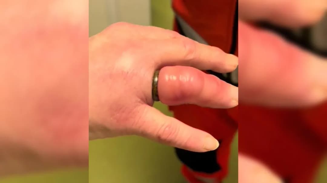 Jak zdjąć obrączkę nitką i uniknąć bólu przy spuchniętym palcu